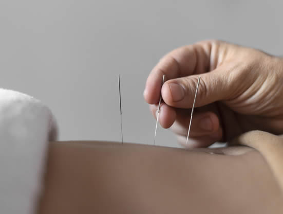 Dry Needling